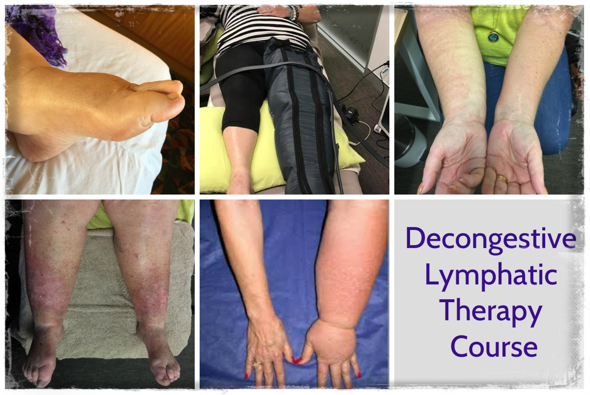 Lymphoedema Training Course | Decongestive Lymphatic Therapy ...